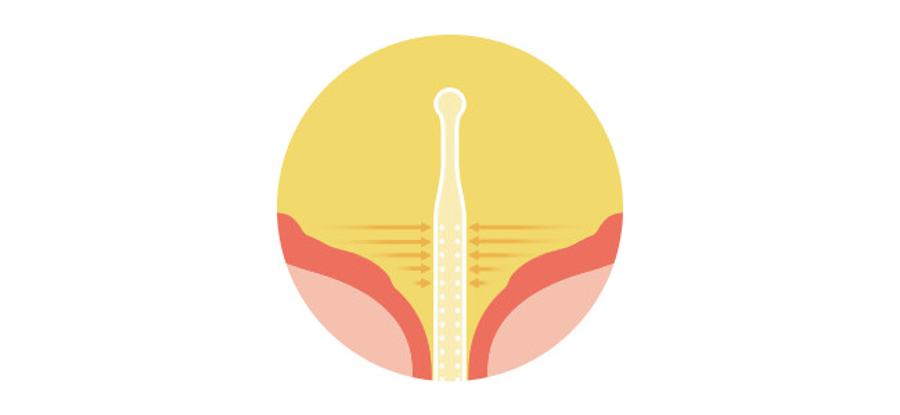 Diagram of a Luja catheter inside the bladder. Luja’s Micro-hole Zone Technology is designed to drain urine from the bottom of the bladder and enable an uninterrupted and free urine flow. 